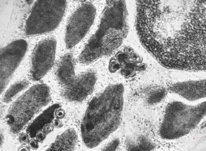 M,3y. | mast cell - granules with scroll-like formations - n. suralis, Krabbe globoid leukodystrophy M,3y. | mast cell - granules with scroll-like formations - n. suralis, Krabbe globoid leukodystrophy